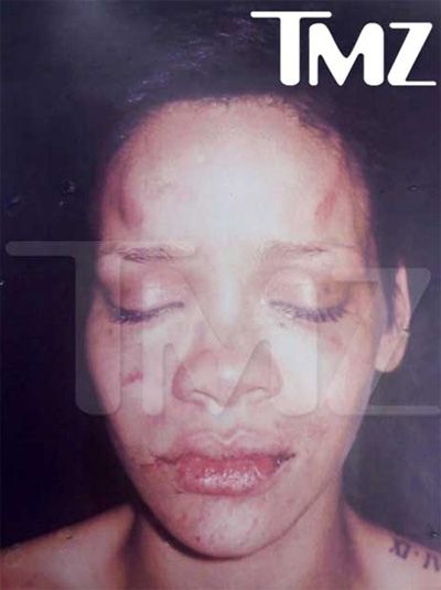Rihanna com o rosto machucado há um ano e meio