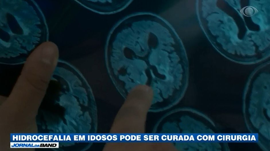 Hidrocefalia De Press O Normal Pode Ser Curada Cirurgia Not Cias