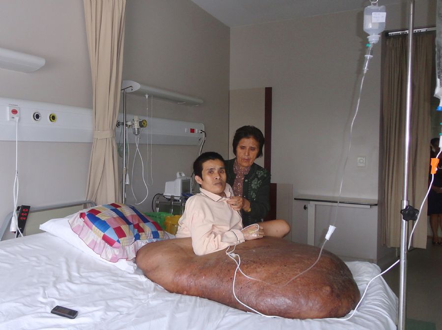 Vietnamita tem tumor de aproximadamente 90 quilos / FV Hospital / AFP